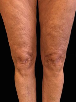 Skin Tyte Before Skin Tyte Before