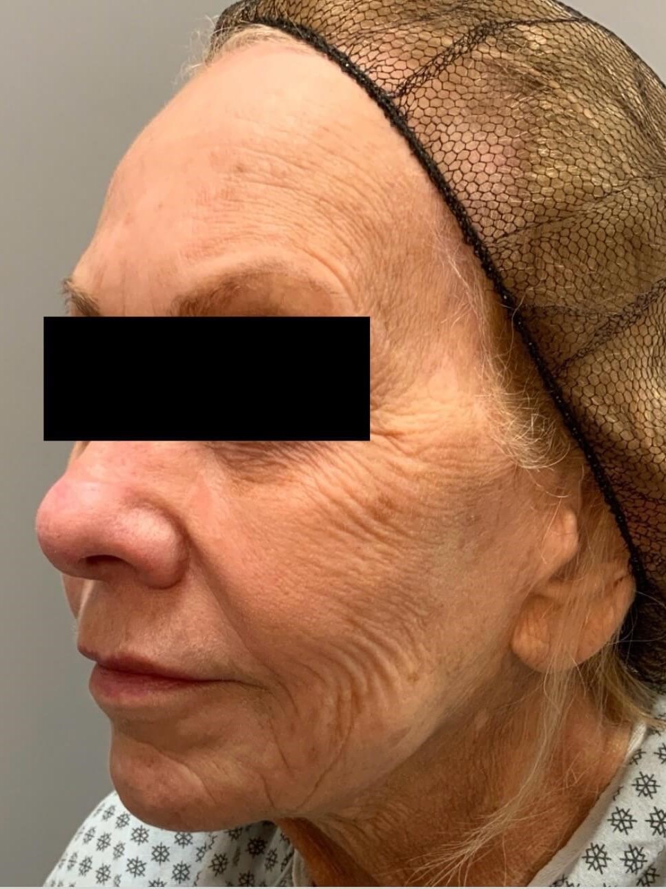 Angled view Before Angled view Before