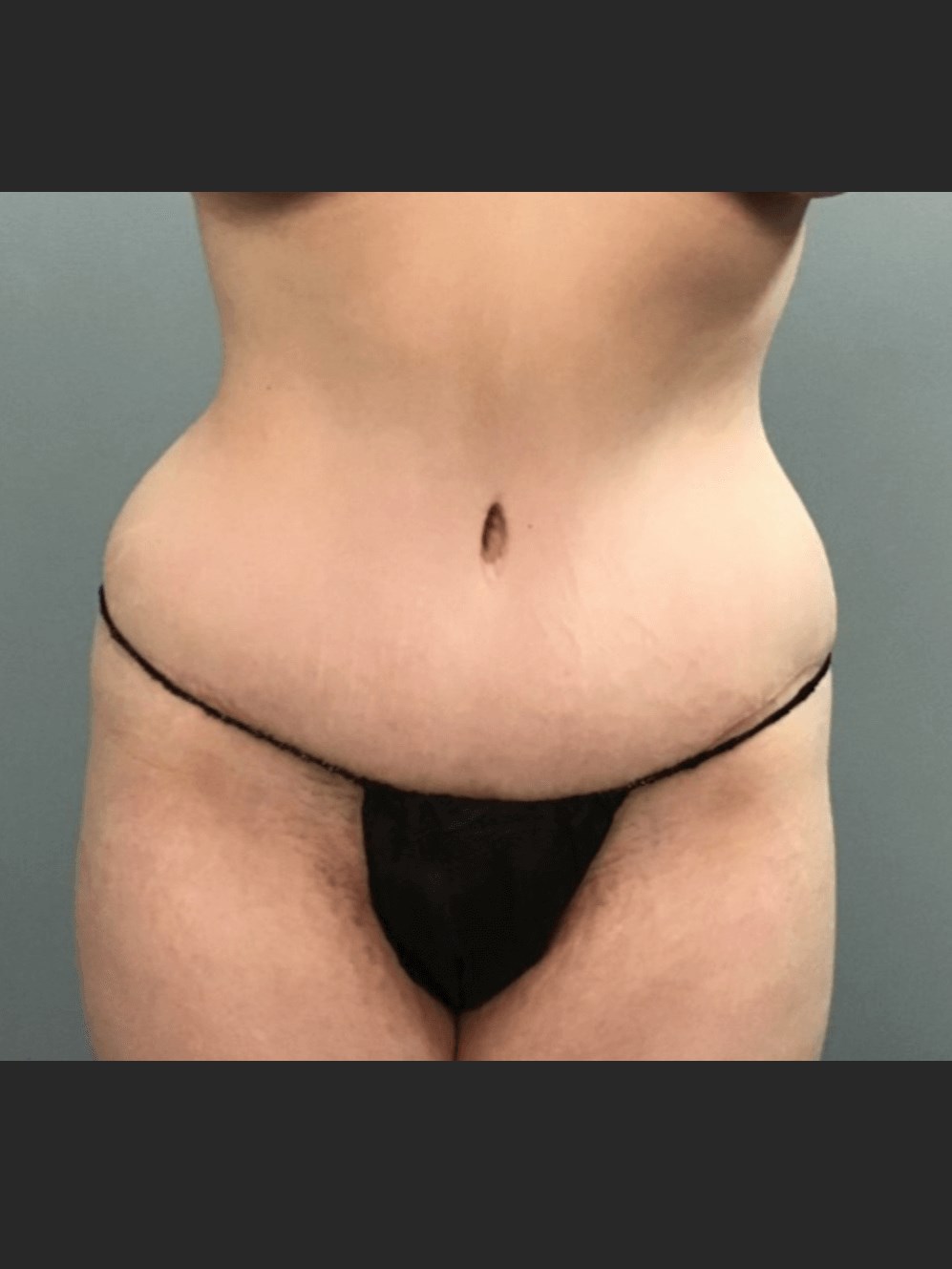 Front View After Front View After
