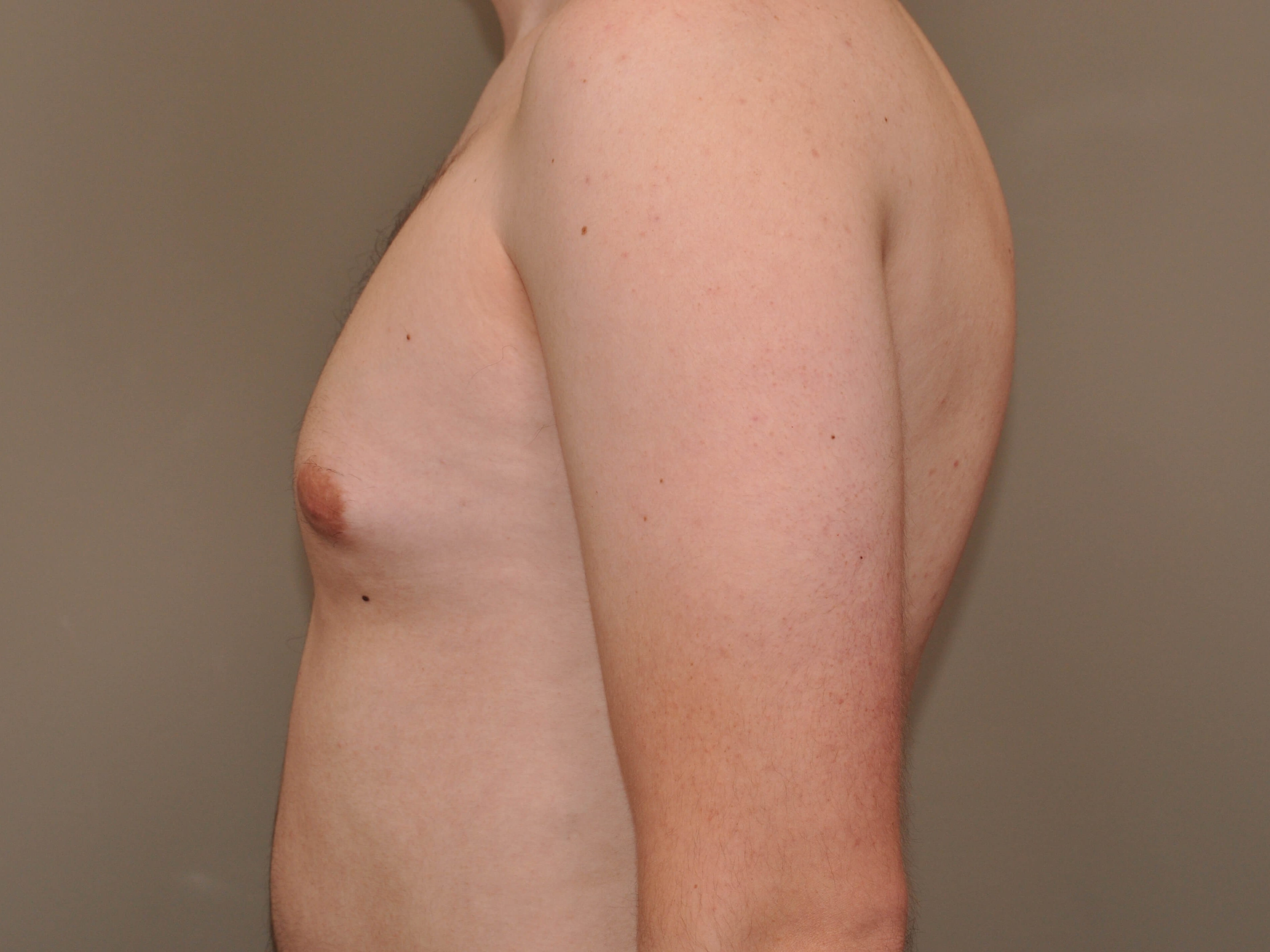 Gynecomastia side view Before Gynecomastia side view Before