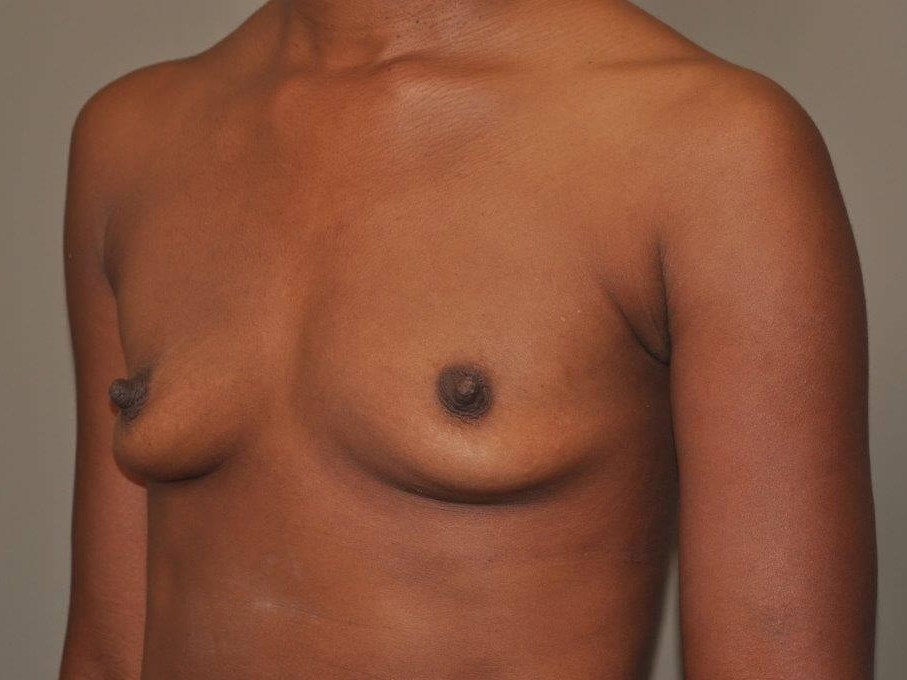 Breast Augmentation Angle View Before Breast Augmentation Angle View Before