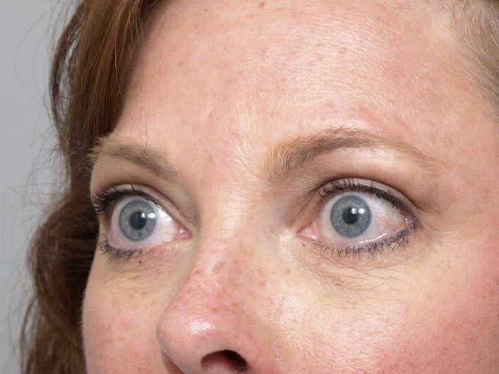 Lower Bleph Left Angled View After Lower Bleph Left Angled View After