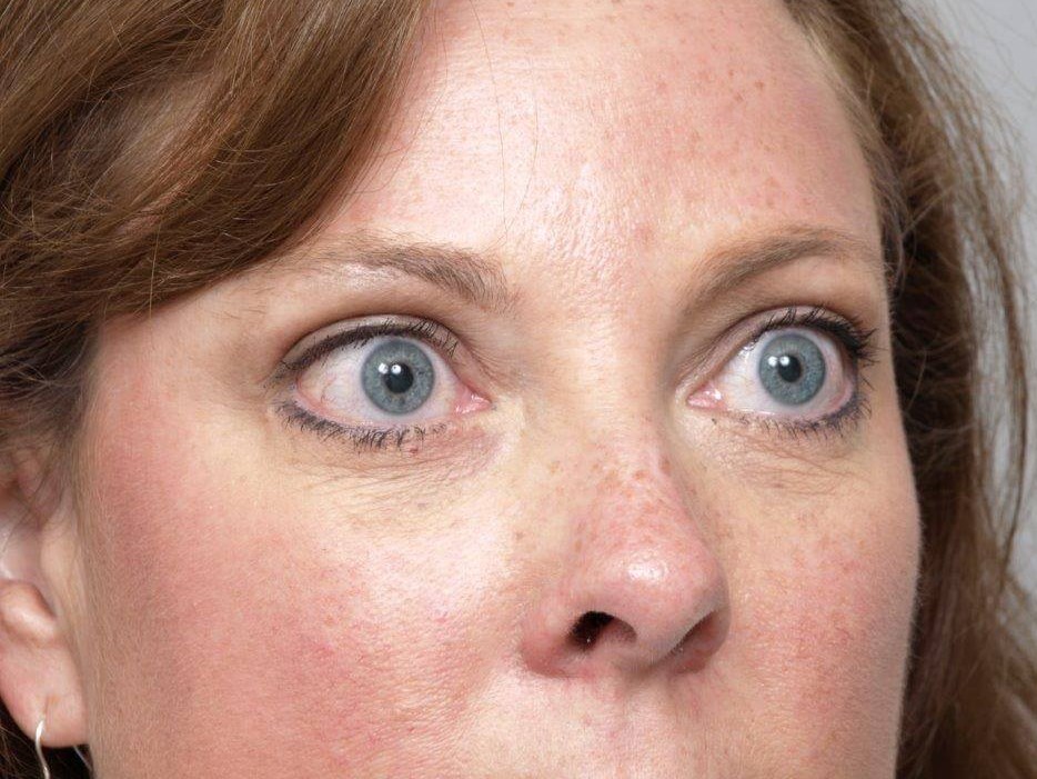 Lower Bleph Right Angled View After Lower Bleph Right Angled View After