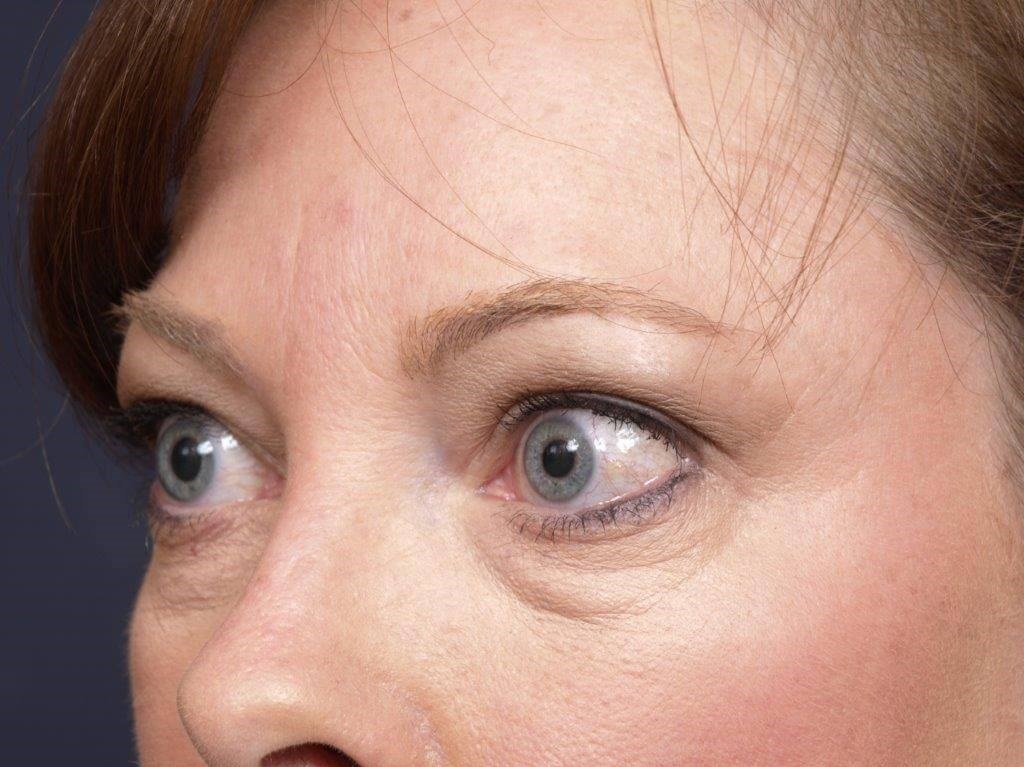 Lower Bleph Left Angled View Before Lower Bleph Left Angled View Before