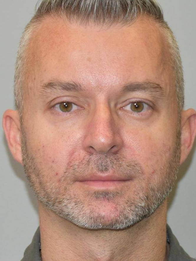 Sculptra Front View After Sculptra Front View After