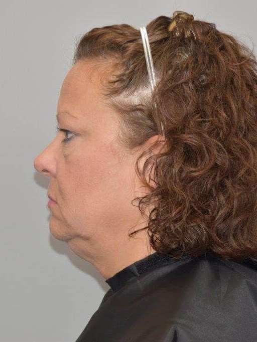 Facelift Left Side View Before Facelift Left Side View Before