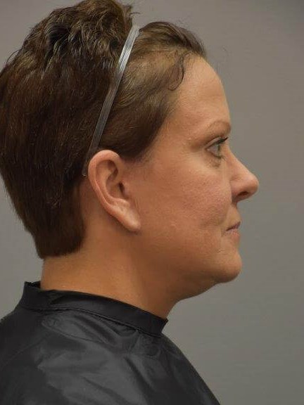 Facelift Right Side View After Facelift Right Side View After