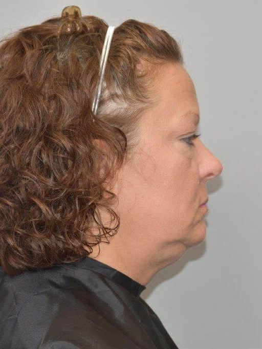 Facelift Right Side View Before Facelift Right Side View Before