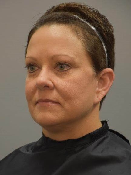 Facelift Left Angled View After Facelift Left Angled View After