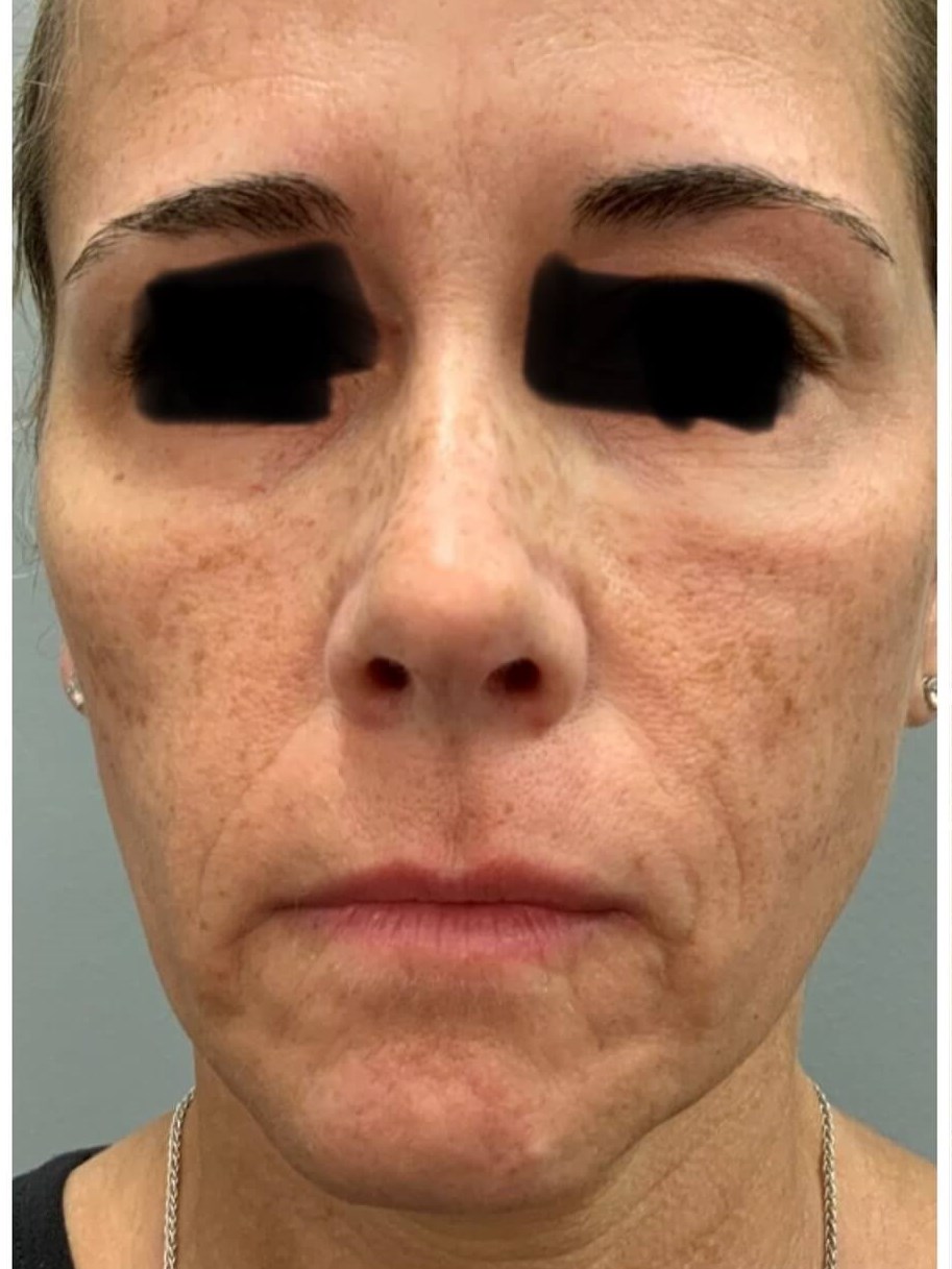 BBL Photofacial Before