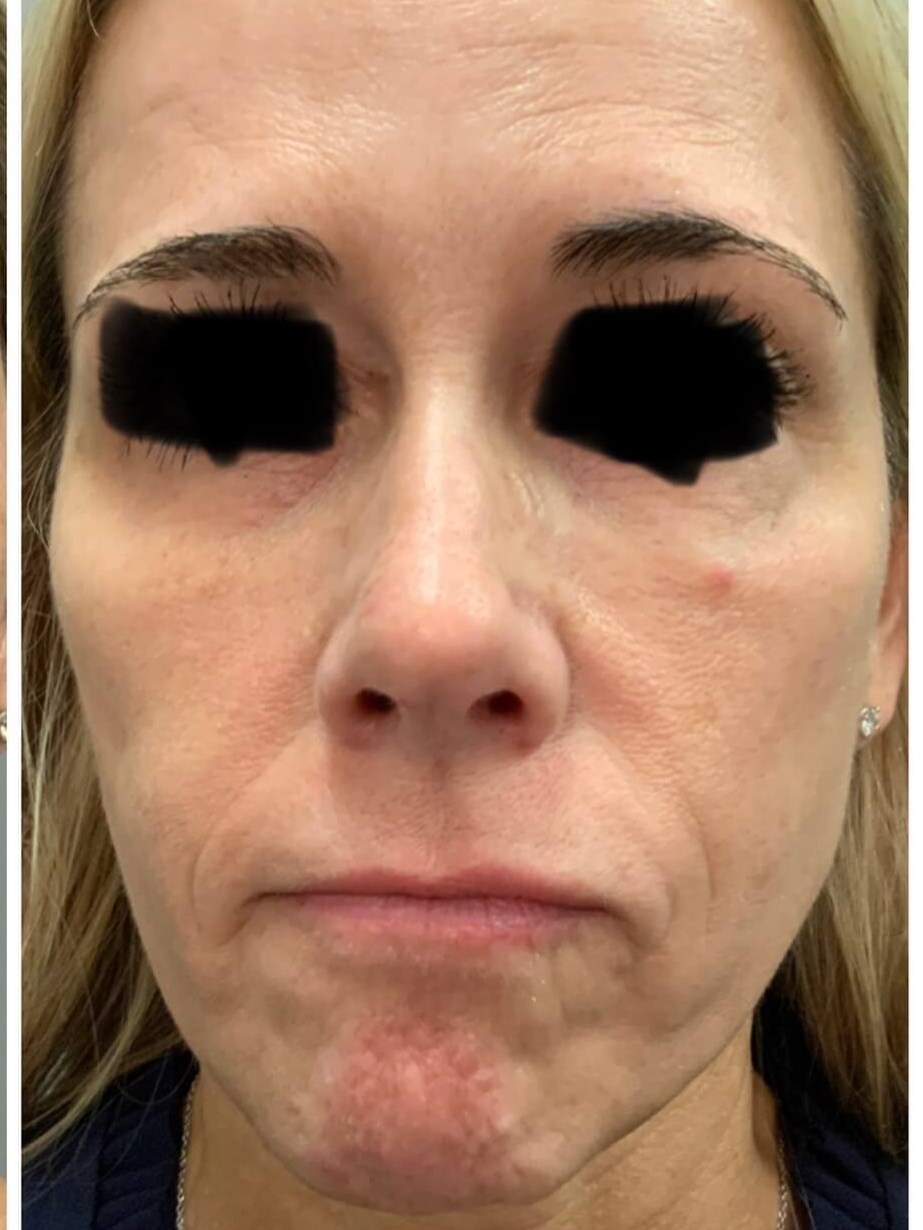 BBL Photofacial After