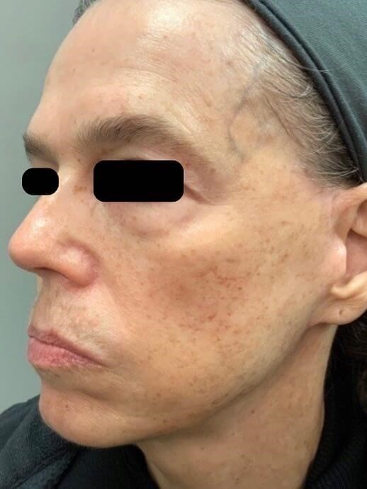 BBL Photofacial Before