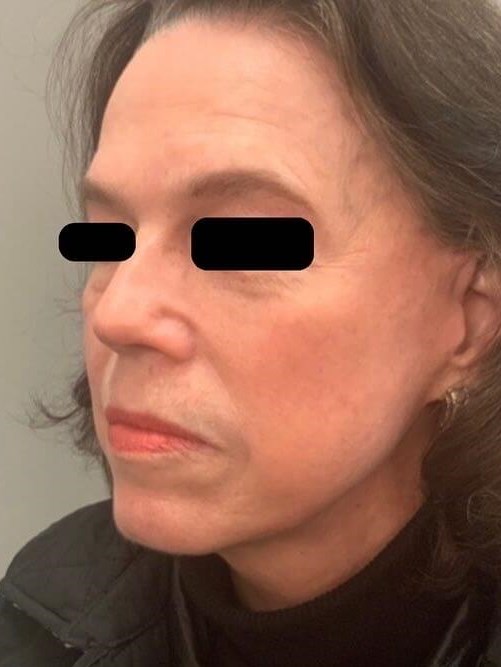 BBL Photofacial After