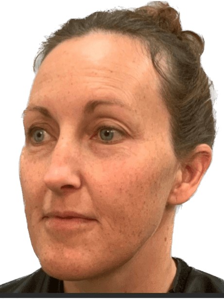 Bandaid Facelift Before