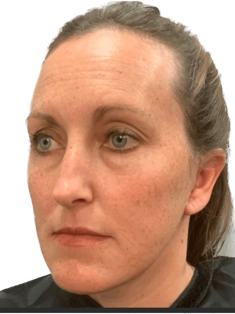 Bandaid Facelift After