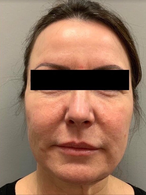 Bandaid Facelift Before