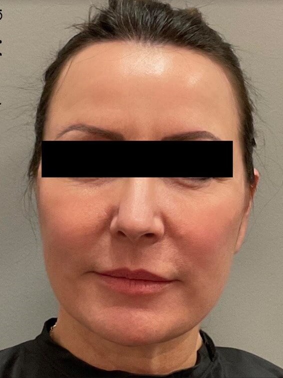Bandaid Facelift After