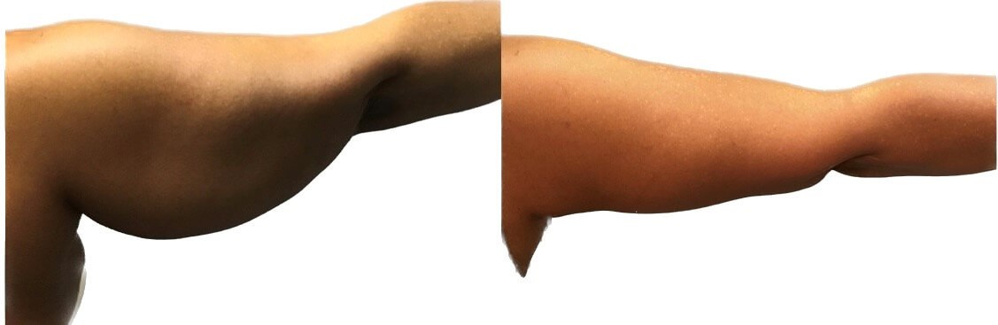 ArmLift (Right Arm) Before