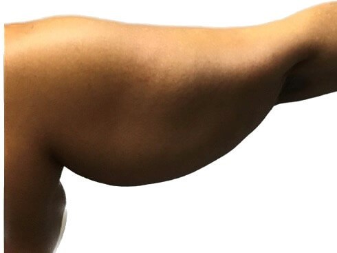 ArmLift (Right Arm) Before