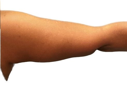 ArmLift (Right Arm) After