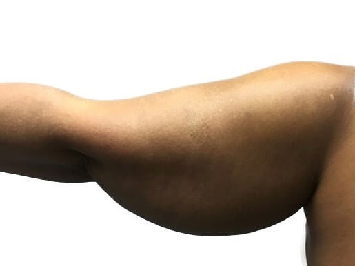 ArmLift (Left Arm) Before