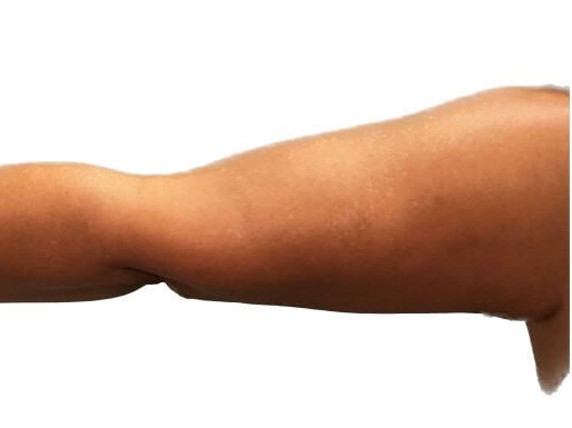 ArmLift (Left Arm) After
