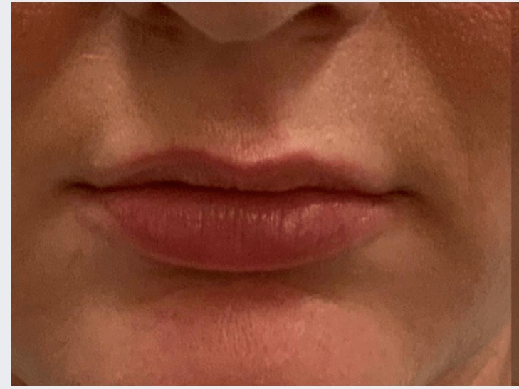 Restylane Kysse Before