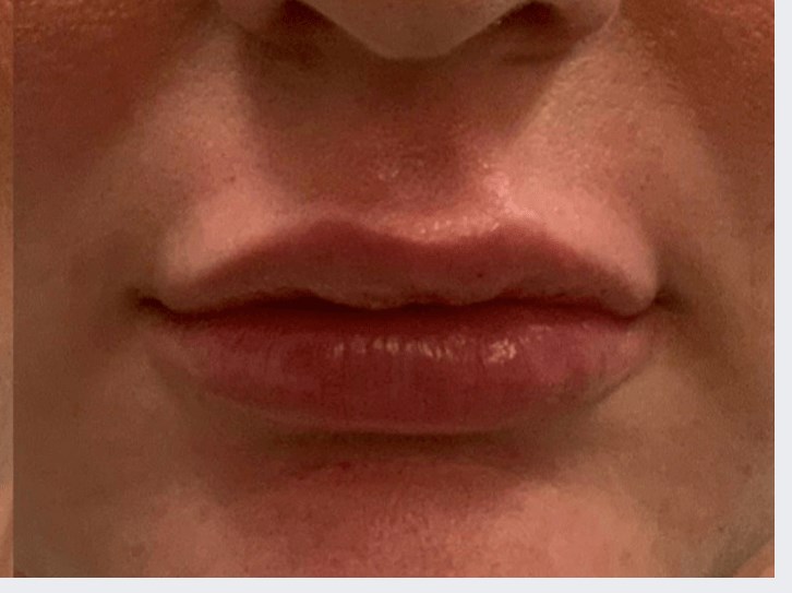 Restylane Kysse After