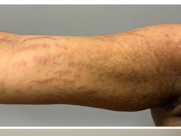 Stretch Mark Reduction Before