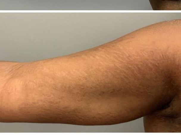 Stretch Mark Reduction After