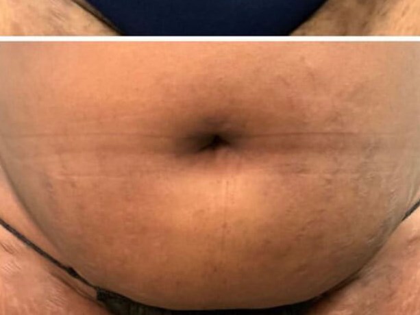 Stretch Mark Reduction After
