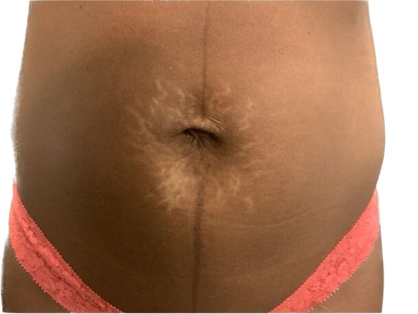 Stretch Mark Reduction Before