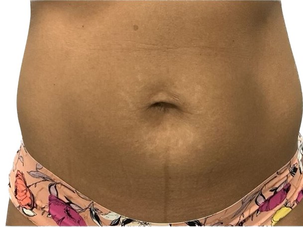 Stretch Mark Reduction After