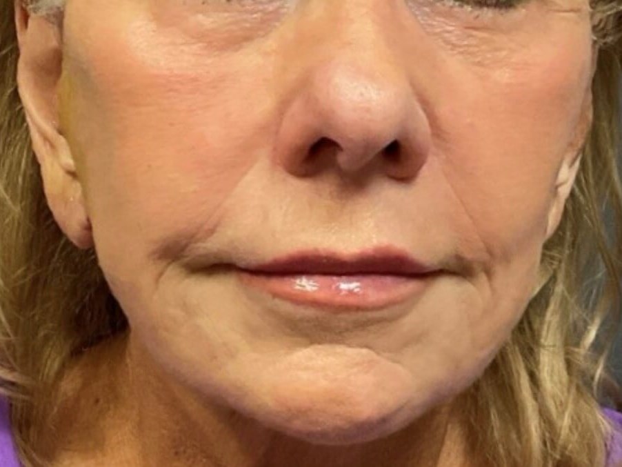Bandaid Facelift (Extended) After