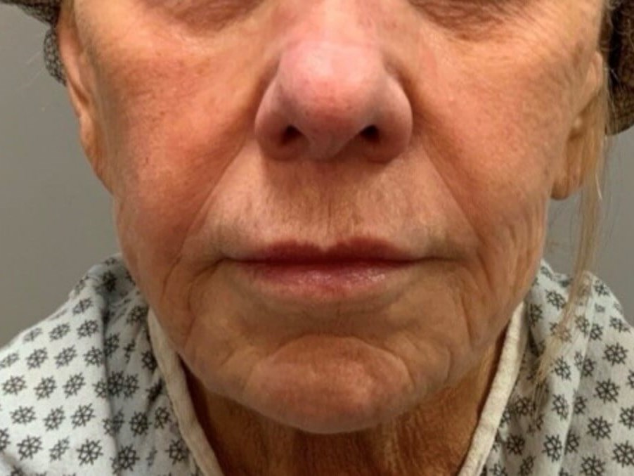 Bandaid Facelift (Extended) Before