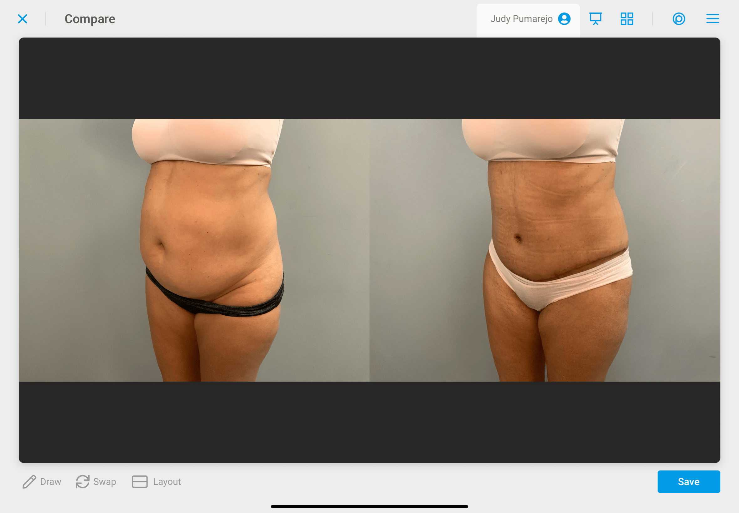 Tummy Tuck Before