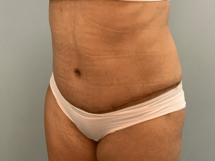 Tummy Tuck After