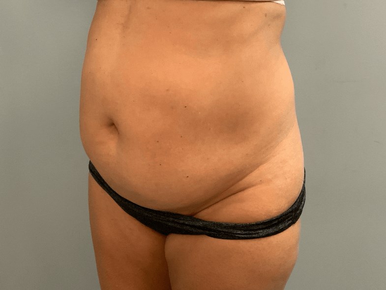 Tummy Tuck Before