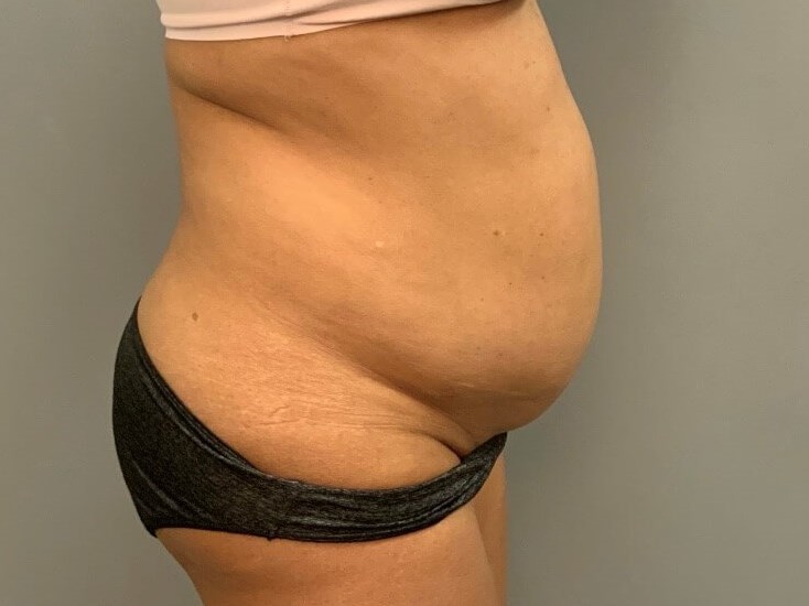 Tummy Tuck Before