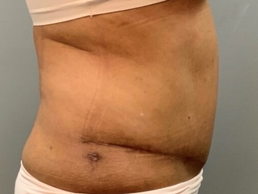 Tummy Tuck After