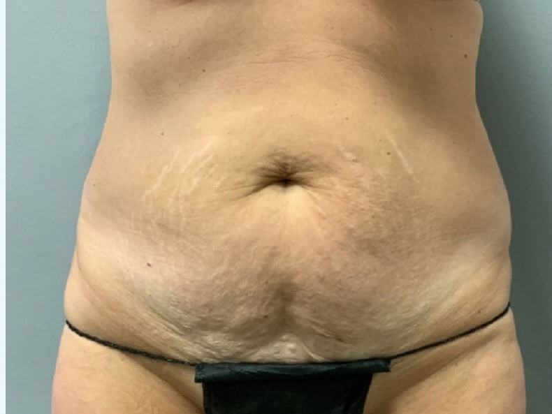 Tummy Tuck Before