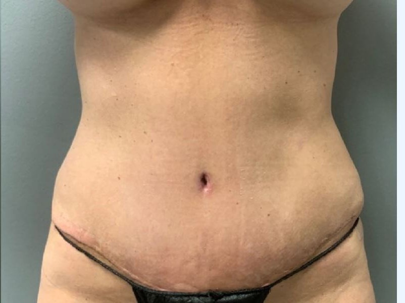 Tummy Tuck After