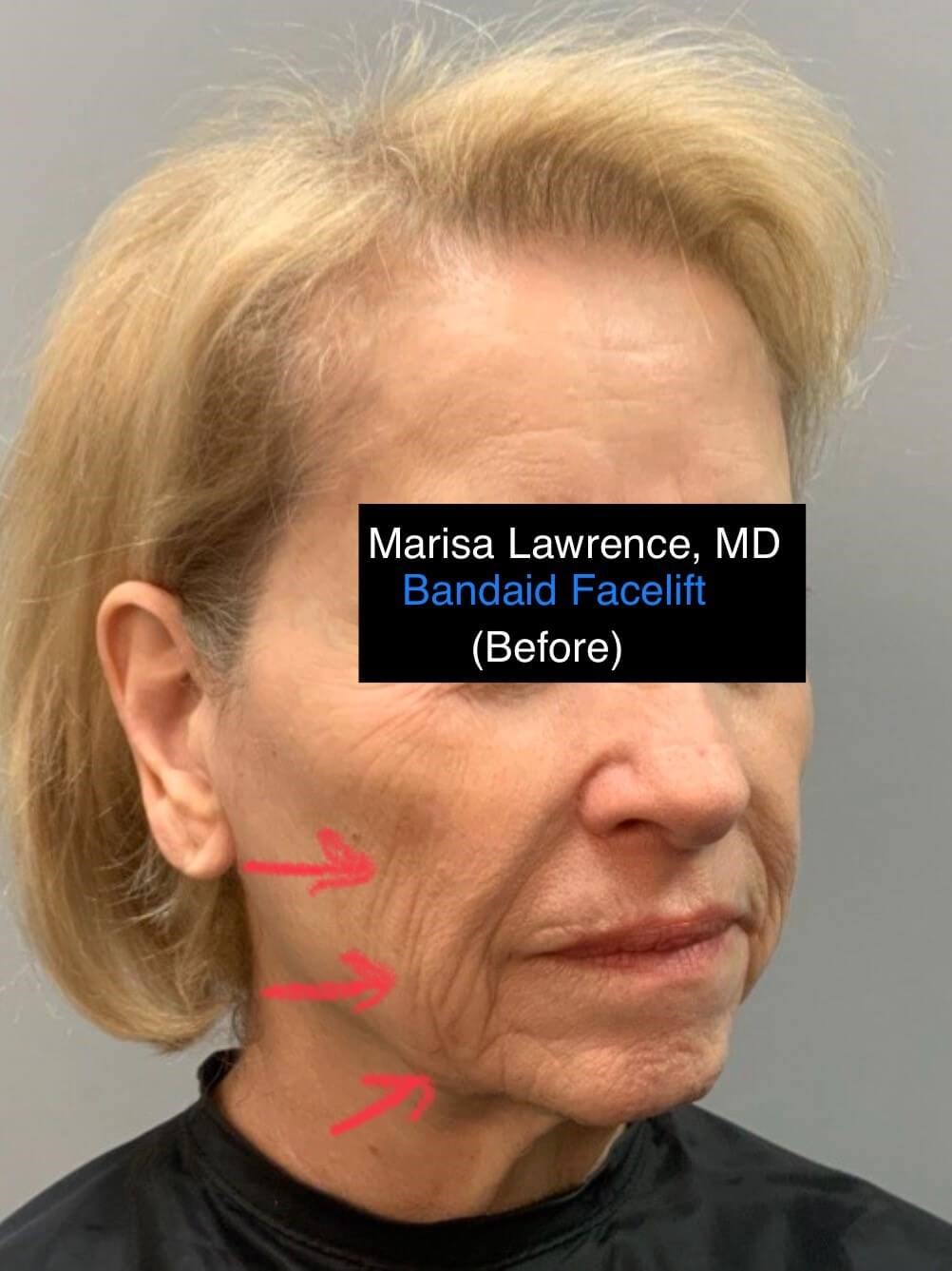 Bandaid Angle Before