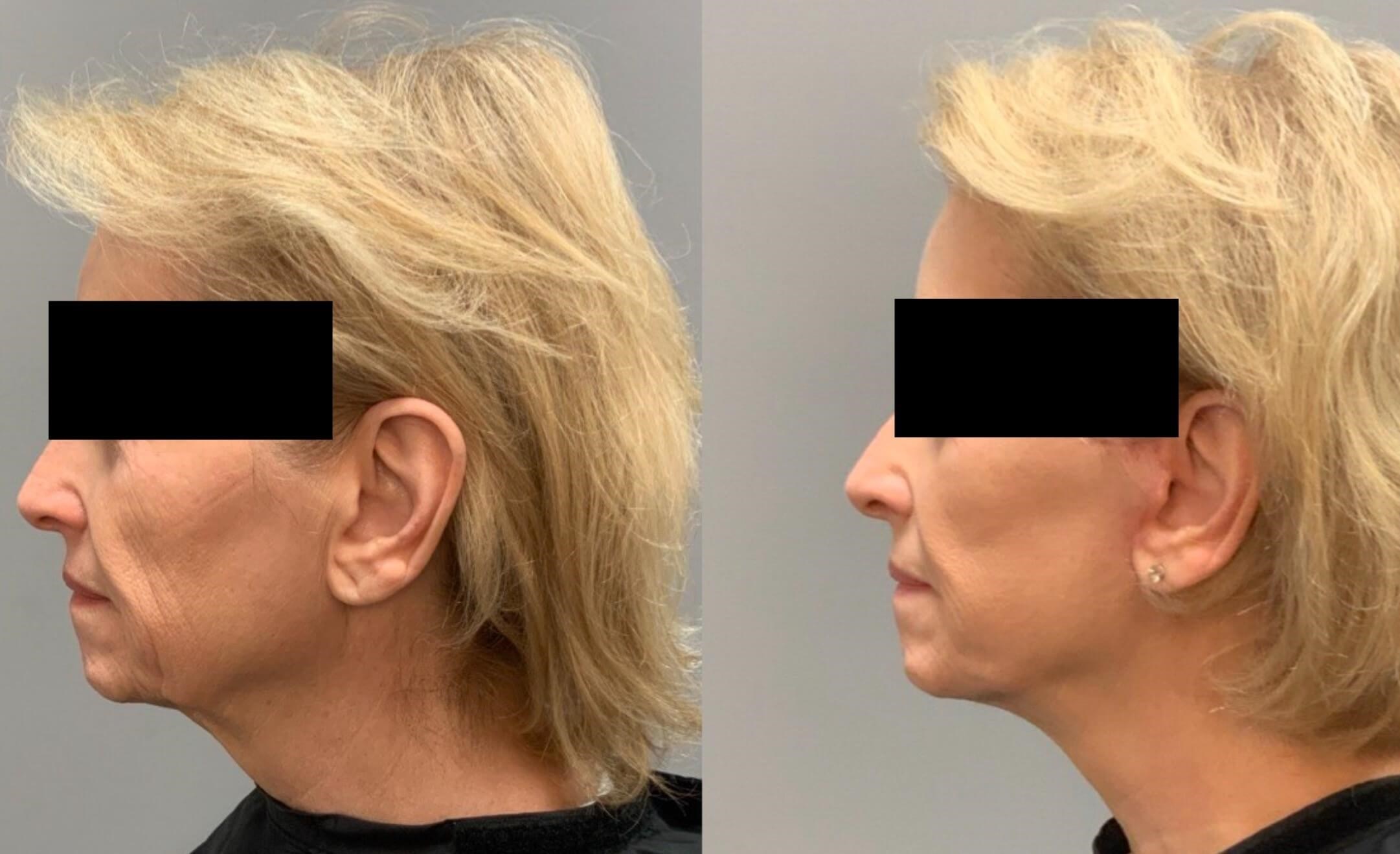 Bandaid Side View Before