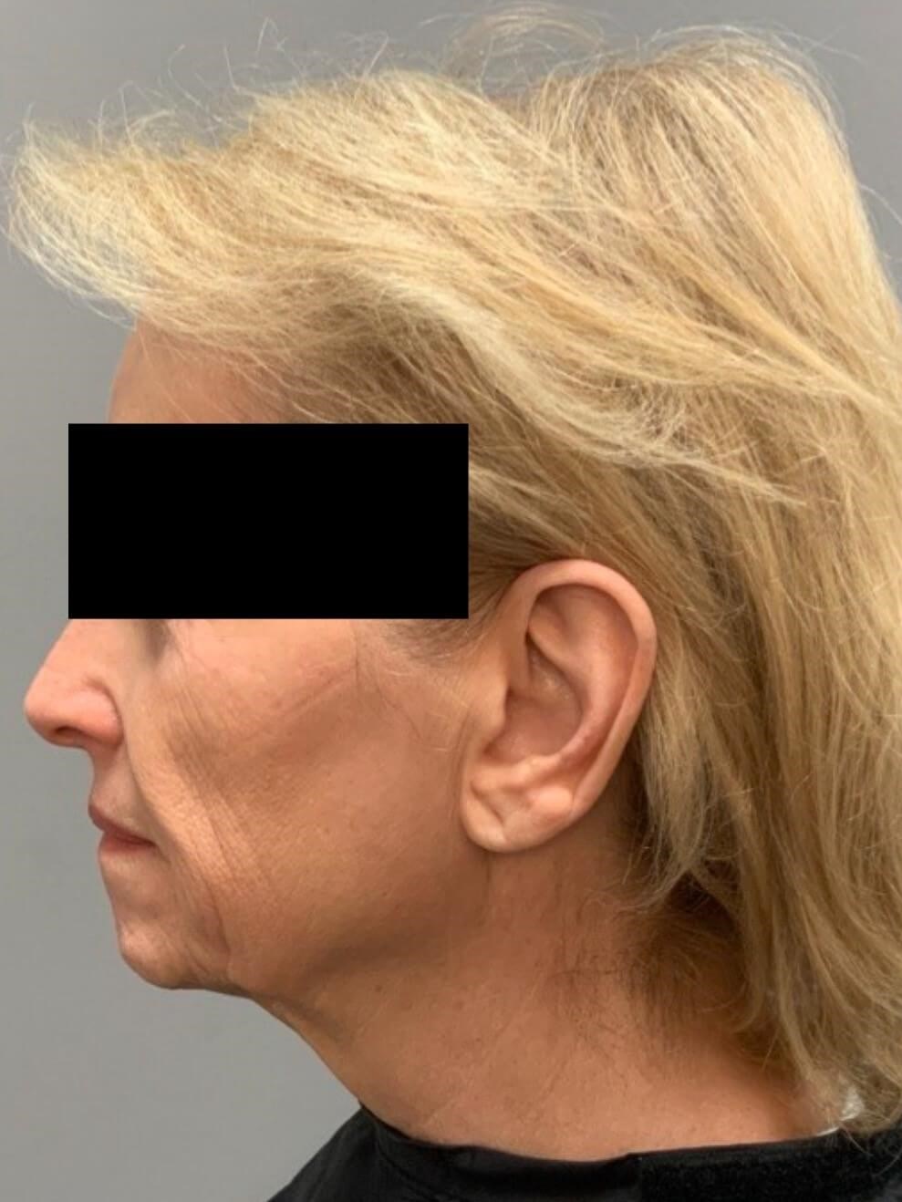 Bandaid Side View Before