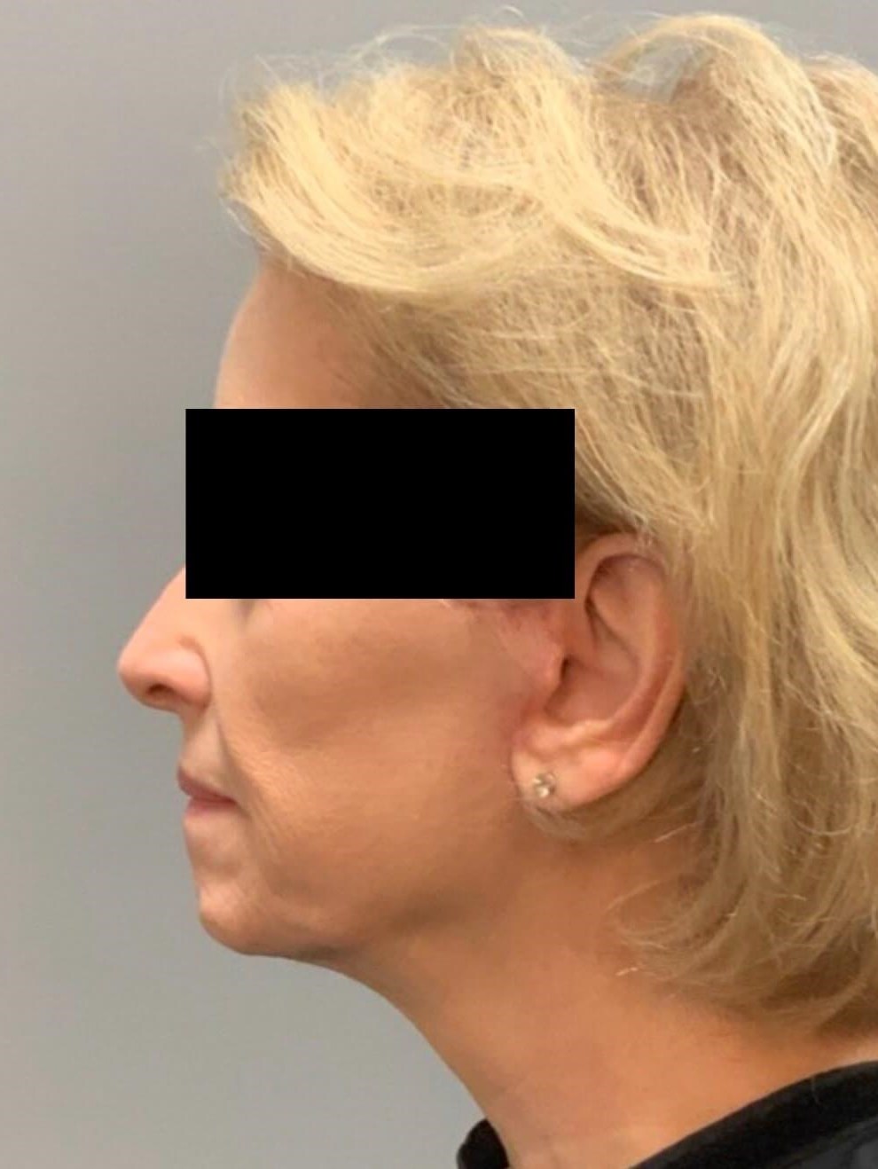 Bandaid Side View After