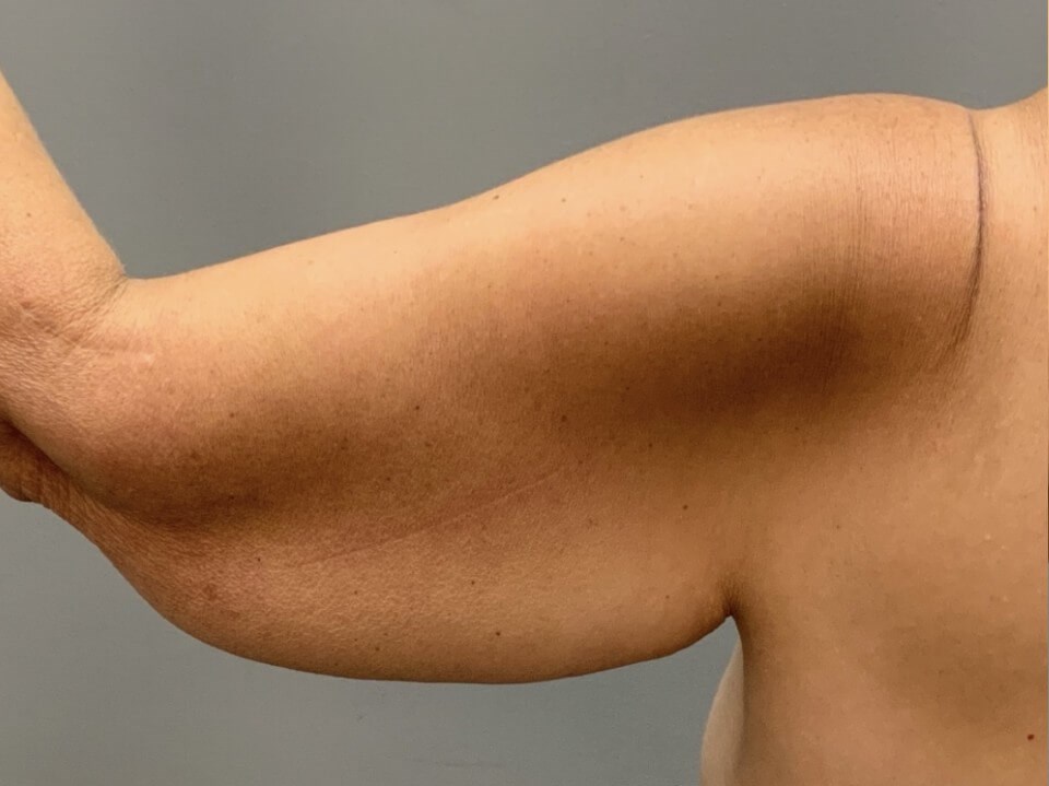 Full Armlift (Back view) Before