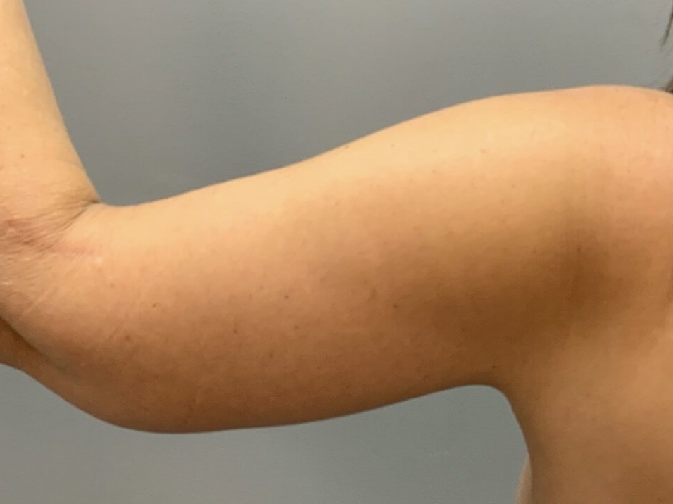 Full Armlift (Back view) After