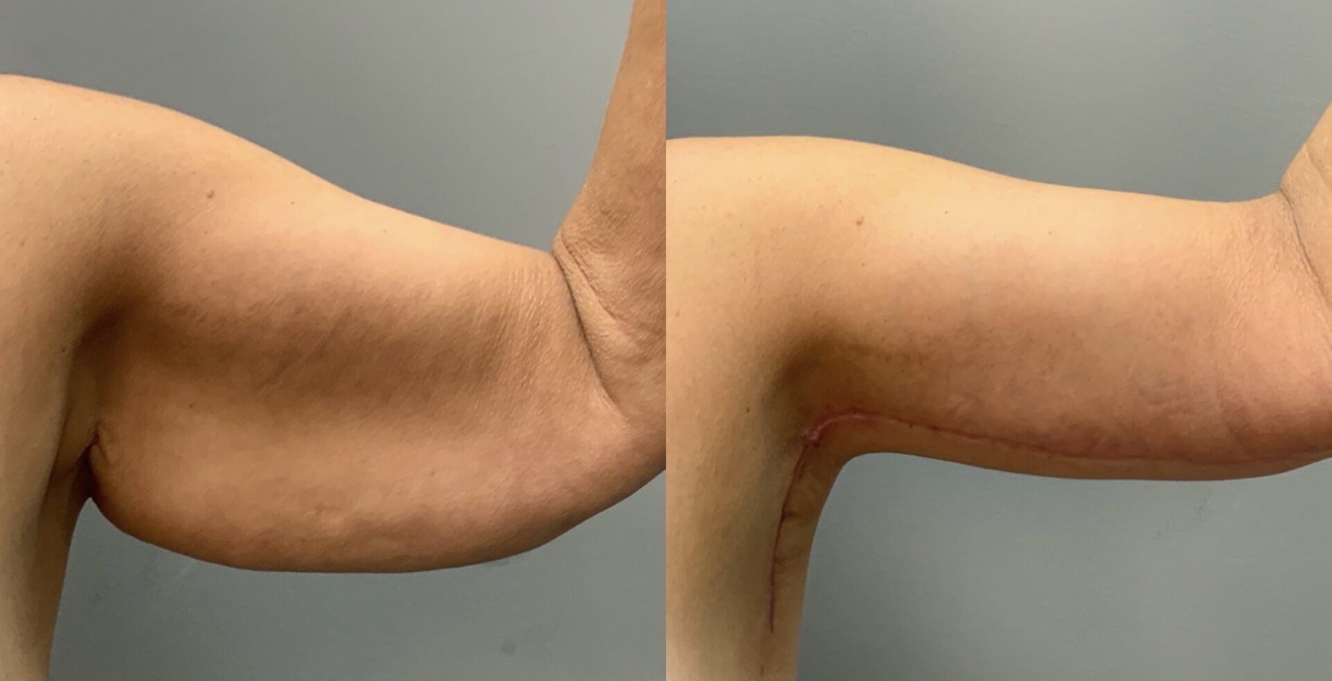 Full Armlift (Front View) Before