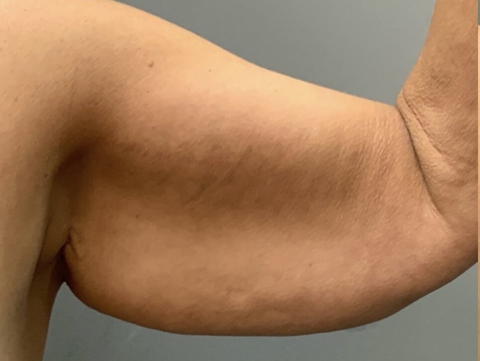 Full Armlift (Front View) Before